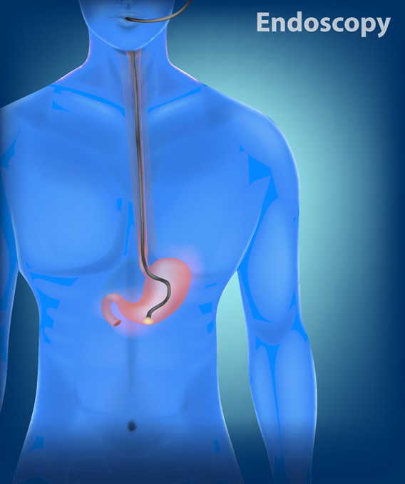 Endoscopy Screening